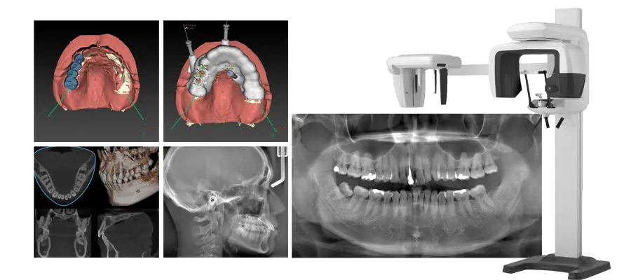 歯科用CT、口腔内スキャナー