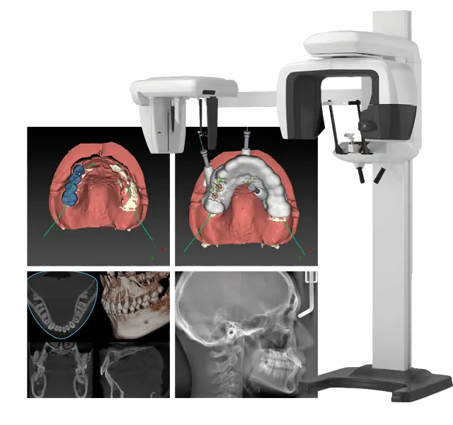 歯科用CT、口腔内スキャナー